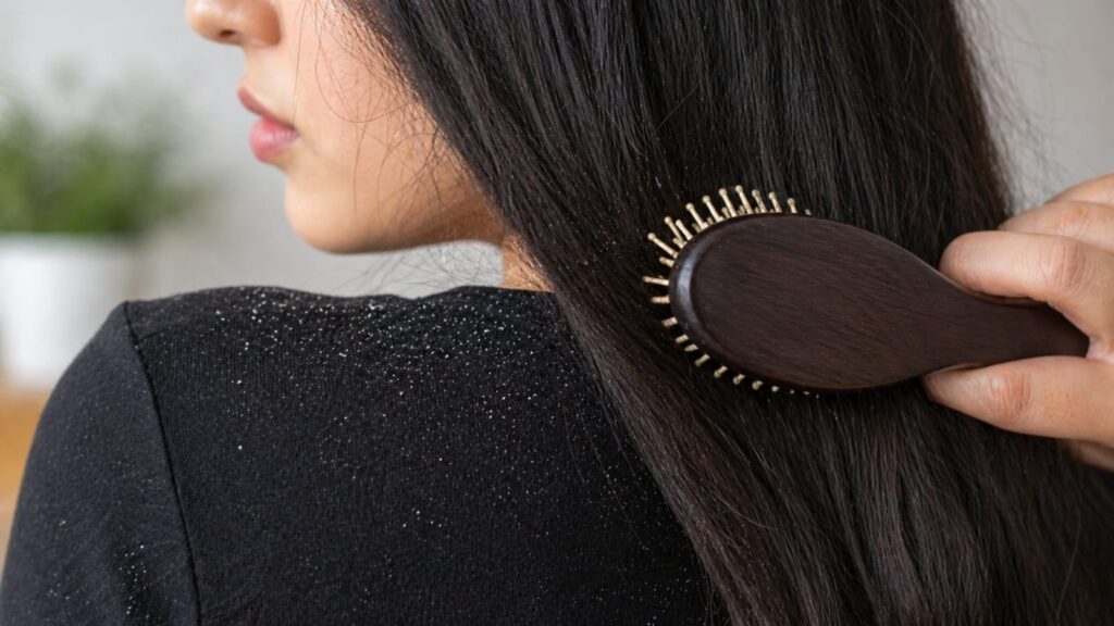 Benefits of Aloe Vera for Dandruff 4